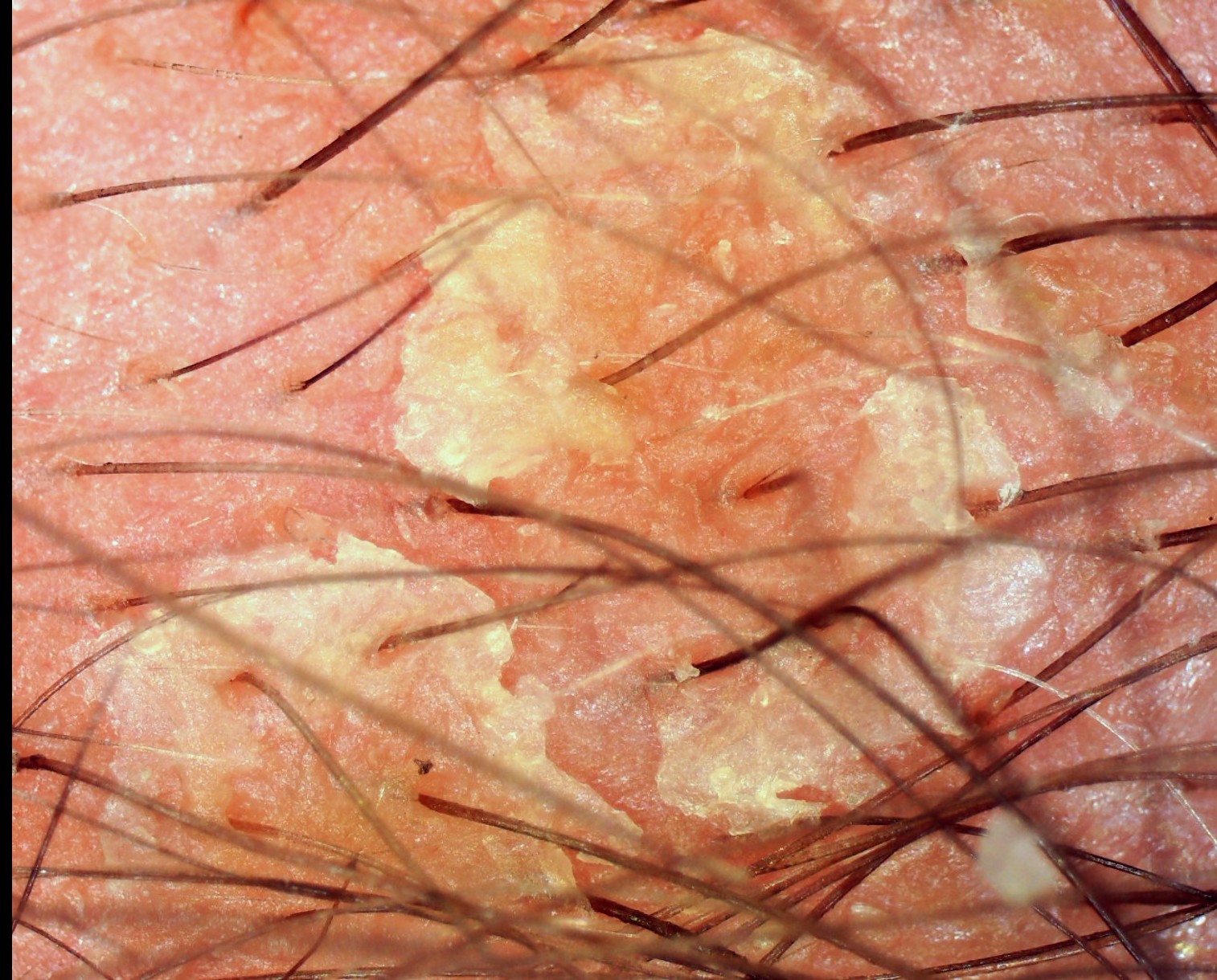Tricoscopia diagnóstica 1