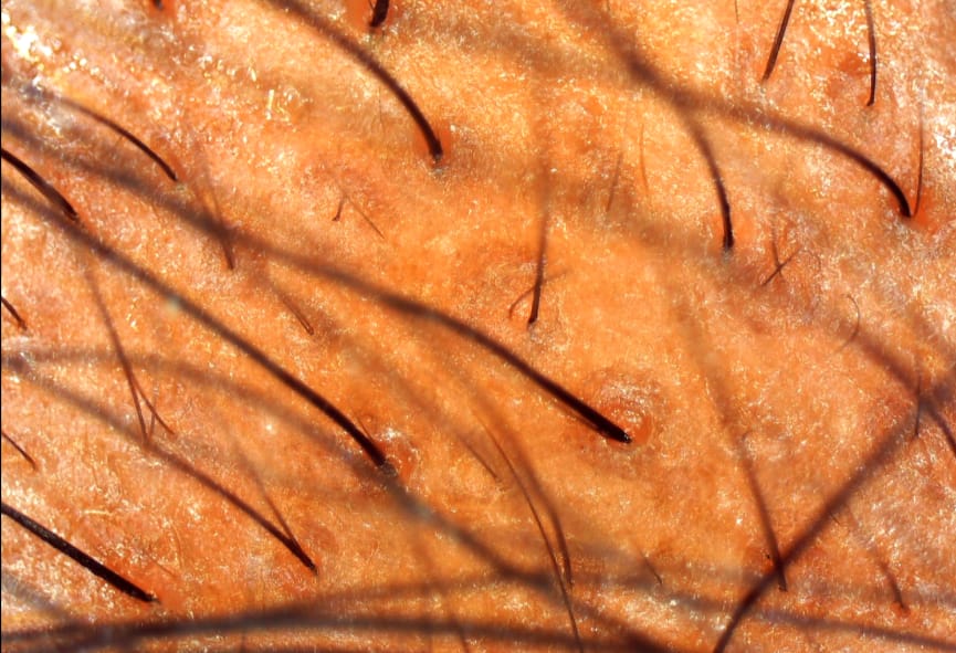 Tricoscopia diagnóstica 2